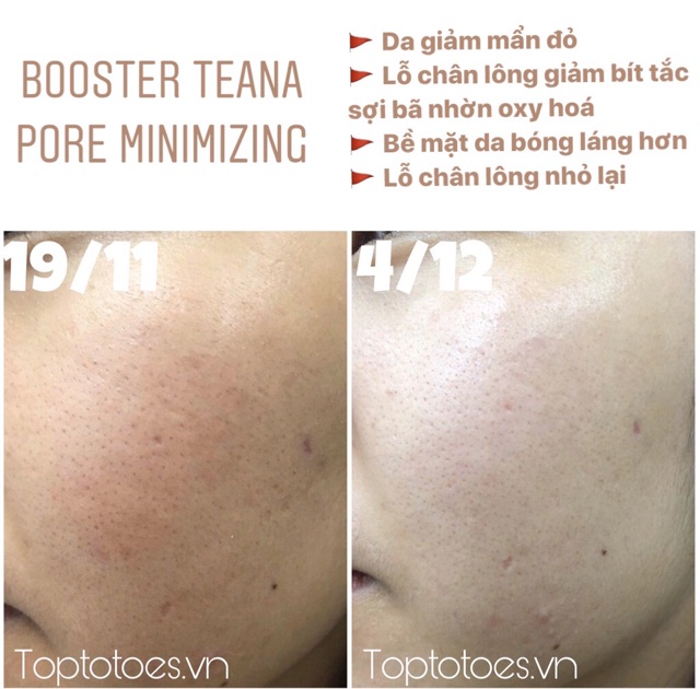 Tinh chất dưỡng Teana Pore Minimizing Booster 20ml giúp se nhỏ lỗ chân lông, giảm ...