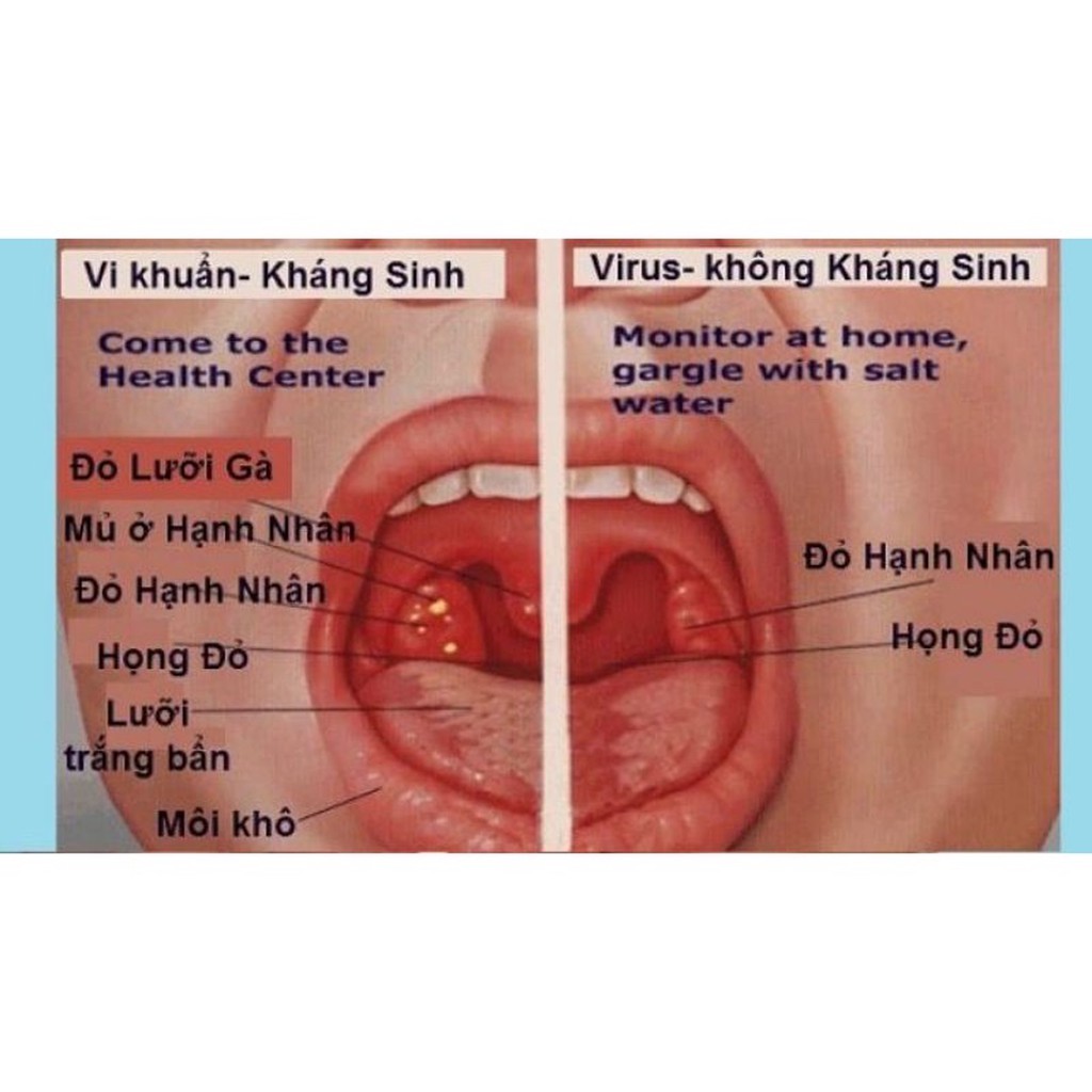 Viêm họng Amidan ho ông cụ làng nghè