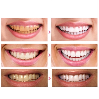 Miếng Dán Làm Trắng Răng Hiệu Quả
