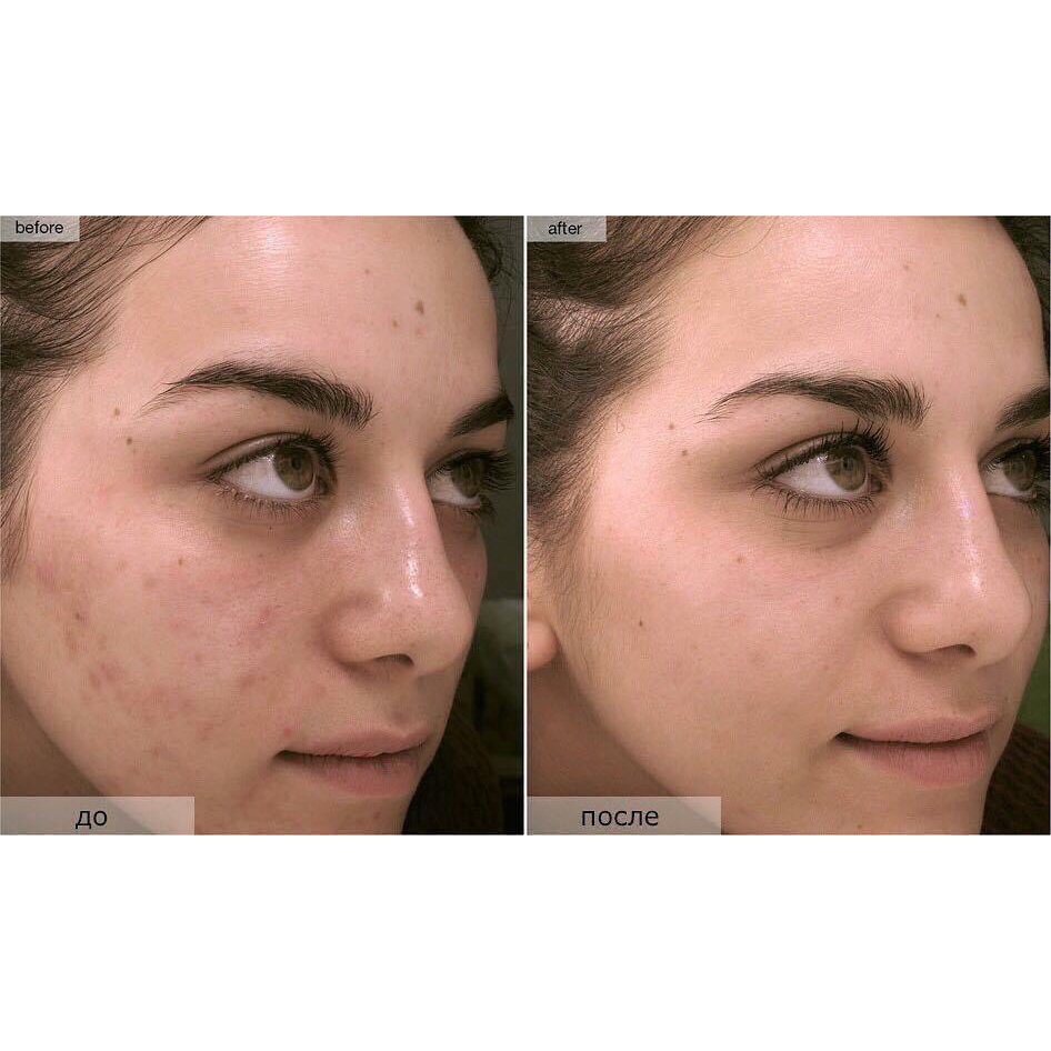 Tinh chất sáng da - serum se khít lỗ chân lông Niacinamide 10% + ZinC 1% The Ordinary