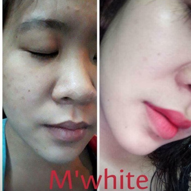 Kem mụn M'white