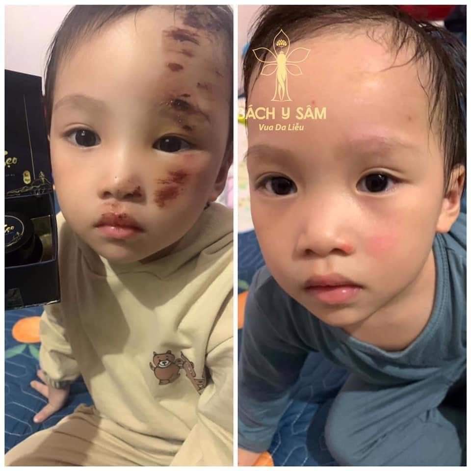 CAO SẸO NHẤT MỘC HƯƠNG DUYÊN THỊ