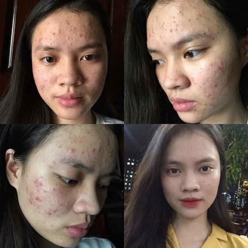 Nước kích bong da 100ml