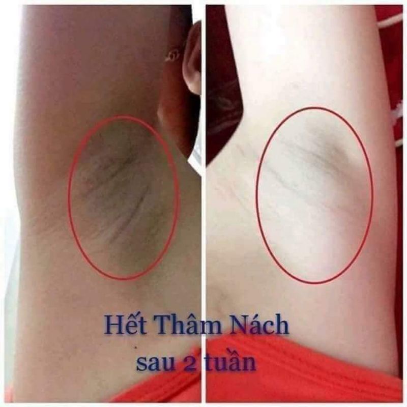 Tinh dầu thâm cao cấp chính hãng (thâm môi, thăm mắt, thâm nách...)