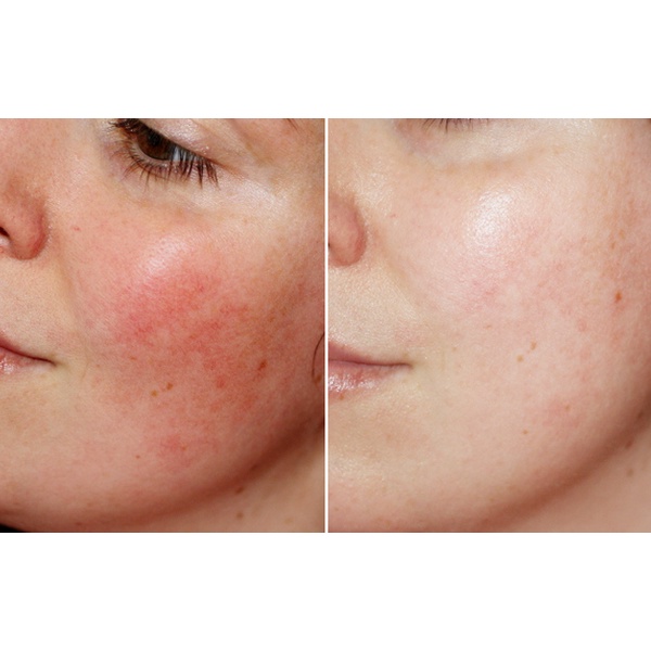 Kem vitamin K Medi Shyn Stem Cell Premium Aesthetic Spa Treatment phục hồi chuyên sâu, khoẻ lớp biểu bì da