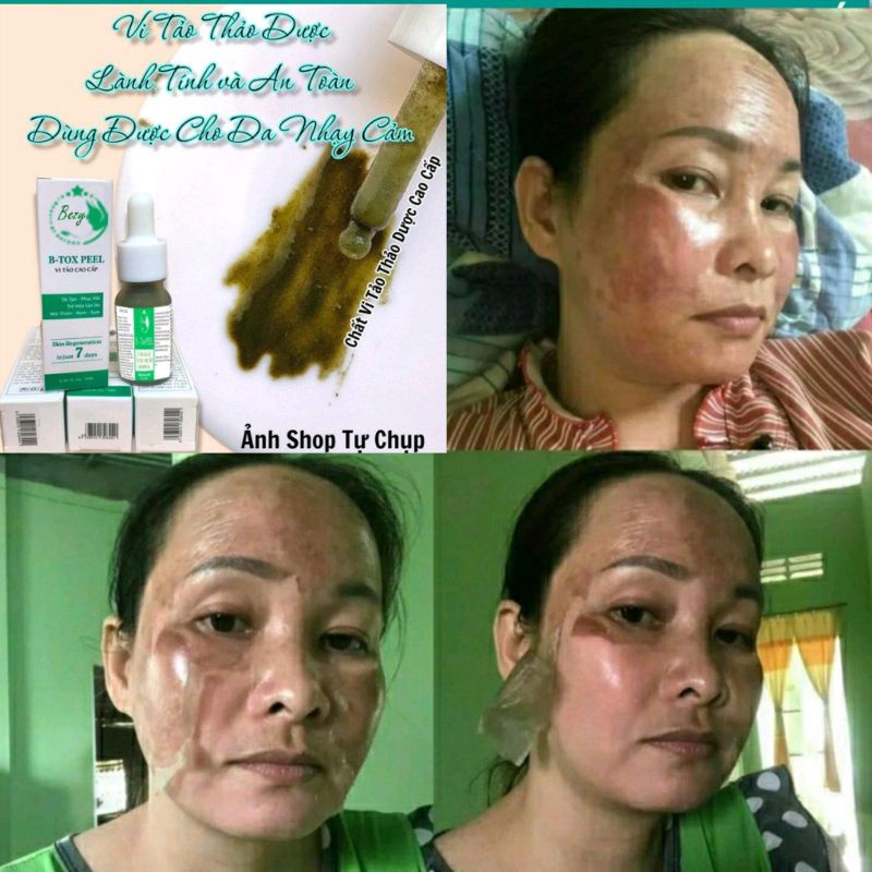 Peel Hút Nám Bong Da Vi Tảo Trắng Da Bezy Cao Cấp