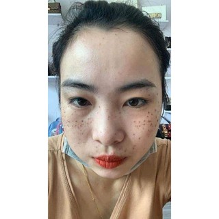 SÉT LẺ TCA CHẤM TÀN NHAN ,SẸO RỔ 50%