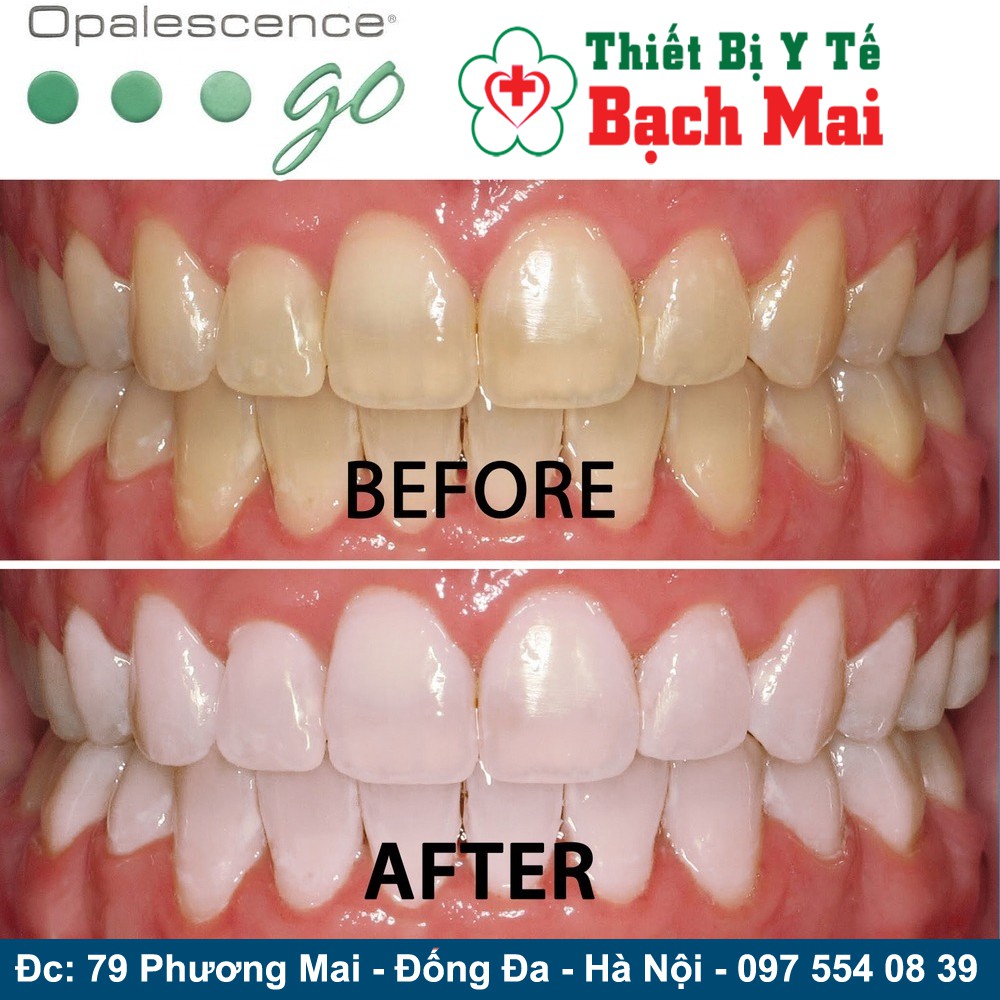 Combo 2 Tuýp Thuốc Tẩy Trắng Opalescence 15% Mỹ