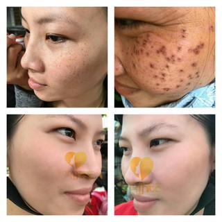 Serum tàn nhang nám sẹo rỗ