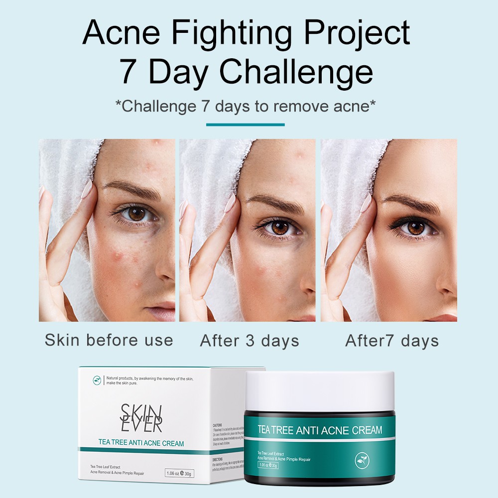 Kem tinh chất tràm trà SKIN EVER 30g cải thiện da mặt bị mụn | BigBuy360 - bigbuy360.vn