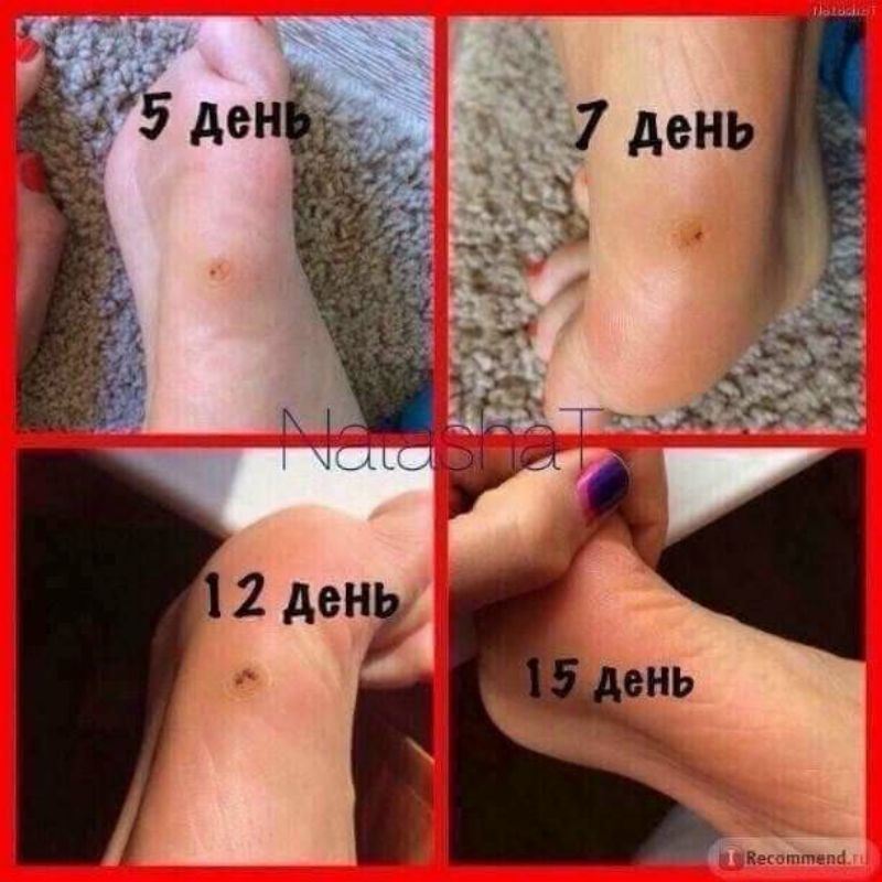 COMBO gel Tẩy Nốt Ruồi Dvelinil và kem bôi Sẹo Klirvin Nga