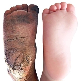 KEM BÔI TRỊ Á SỪNG