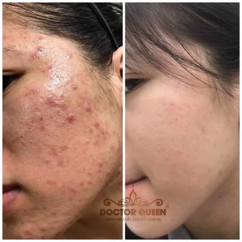 serum tri mụn doctor queen