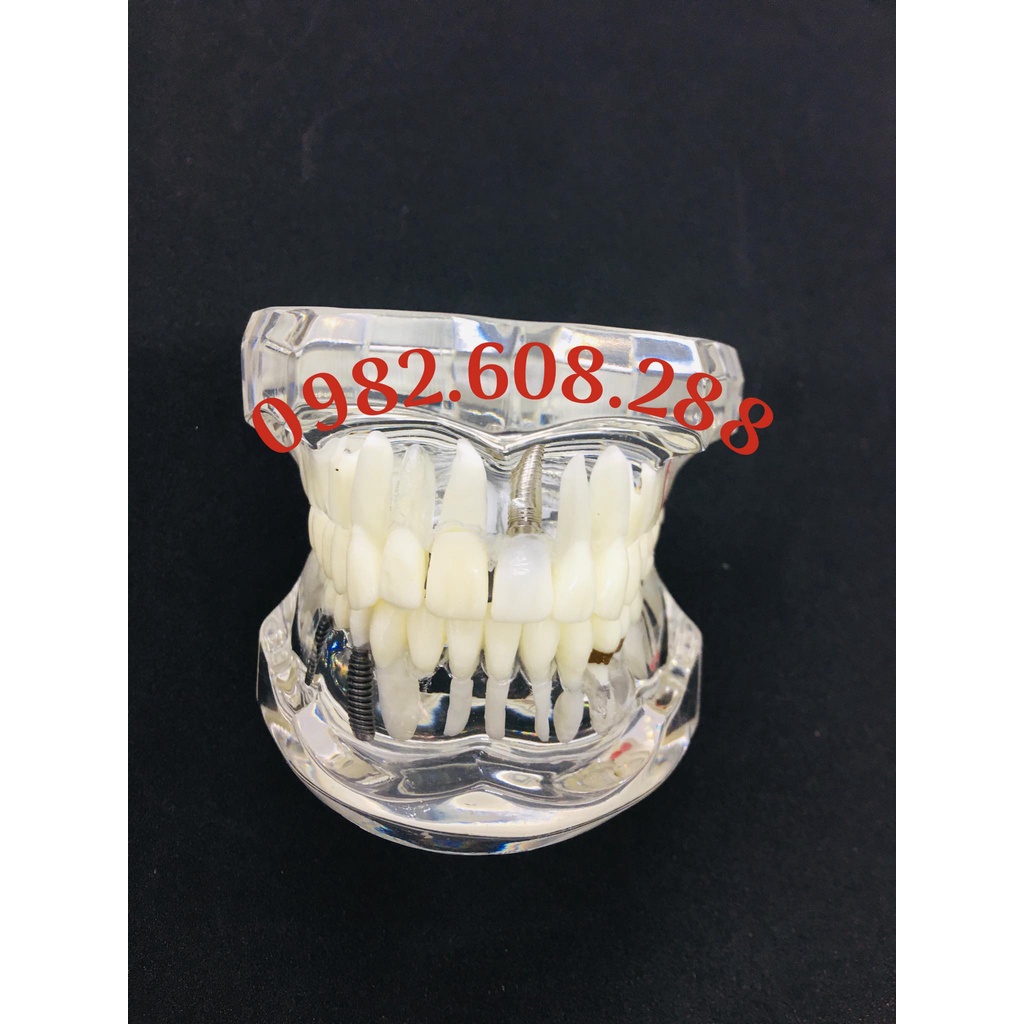 Mẫu hàm tư vấn nha khoa,mô hình tư vấn sâu răng,cắm implant,sún răng