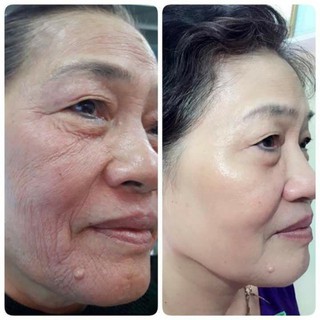 Trẻ hoá da TRUFACE ESSENCE ULTRA (NUSKIN)
