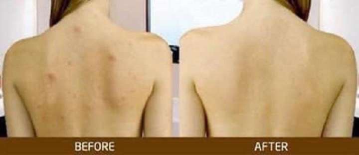 SỮA TẮM ADERMA GIẢM MỤN LƯNG , GIẢM VIÊM LỖ CHÂN LÔNG 500ml - Aderma | BigBuy360 - bigbuy360.vn