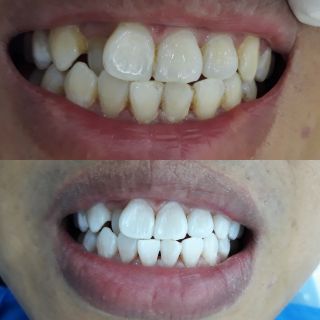 Thuốc TẨY TRẮNG RĂNG