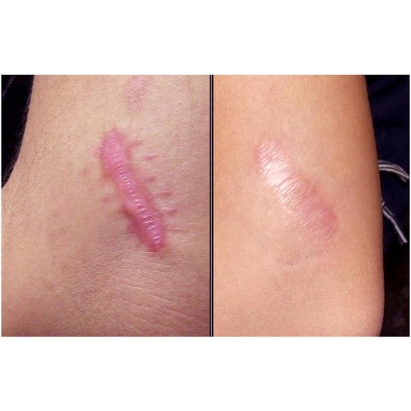 Kem làm mờ sẹo CONTRACTUBEX 30g