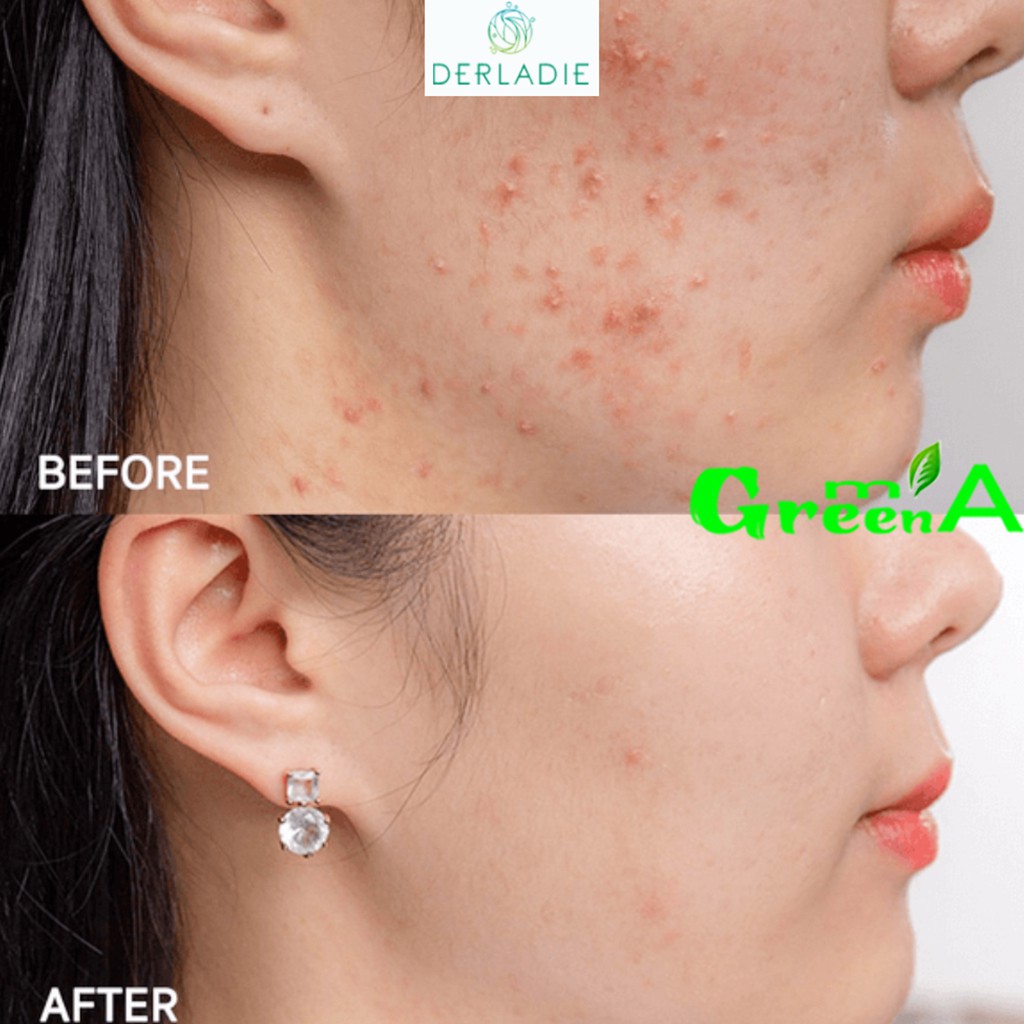 Serum Tràm Trà Derladie Tinh Chất Giảm Mụn Herbal Ampoule For Blemish Hết Mụn Sau 14 Ngày [NHẬP KHẨU CHÍNH HÃNG CÓ TEM]