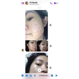 Comboo mụn