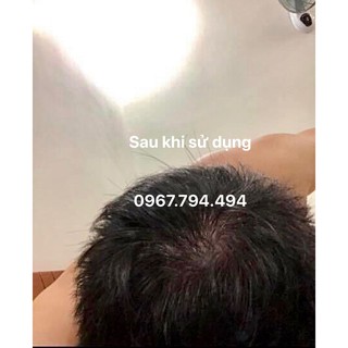 Thuốc mọc tóc Morr F 10%