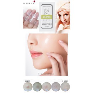 Miếng Dán Mụn Missha Speedy Solution Trouble Patch Set