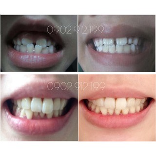 Dụng cụ niềng răng