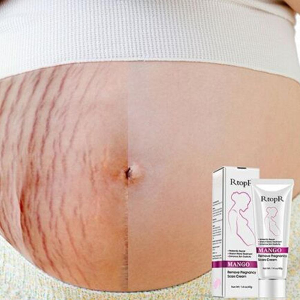 [Hàng mới về] Tuýp kem xoài tự nhiên trị rạn da hiệu Rtopr không gây kích ứng