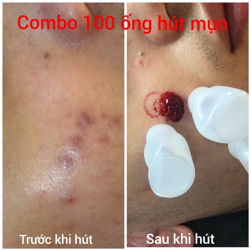 Combo 50 lọ nhựa 5ml dày dùng hút máu bầm.