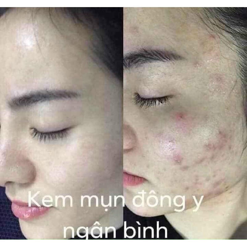 KEM MỤN ĐÔNG Y NGÂN BÌNH 25g - SẠCH MỤN MỜ THÂM LIỀN SẸO