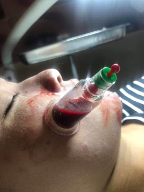 Bộ giác hơi hút máu bầm 10 ống