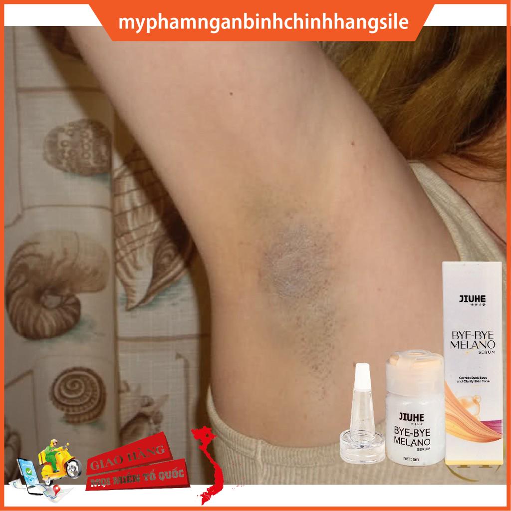 Serum mờ thâm hàn quốc JIUHE Q-PEARL giảm thâm do mụn khửu tay chân, thâm sẹo, thâm nách hiệu quả