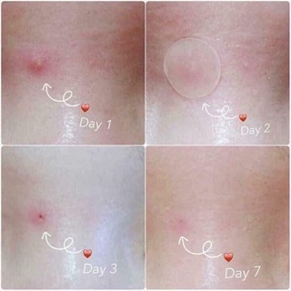 Miếng dán hút mụn some by mi