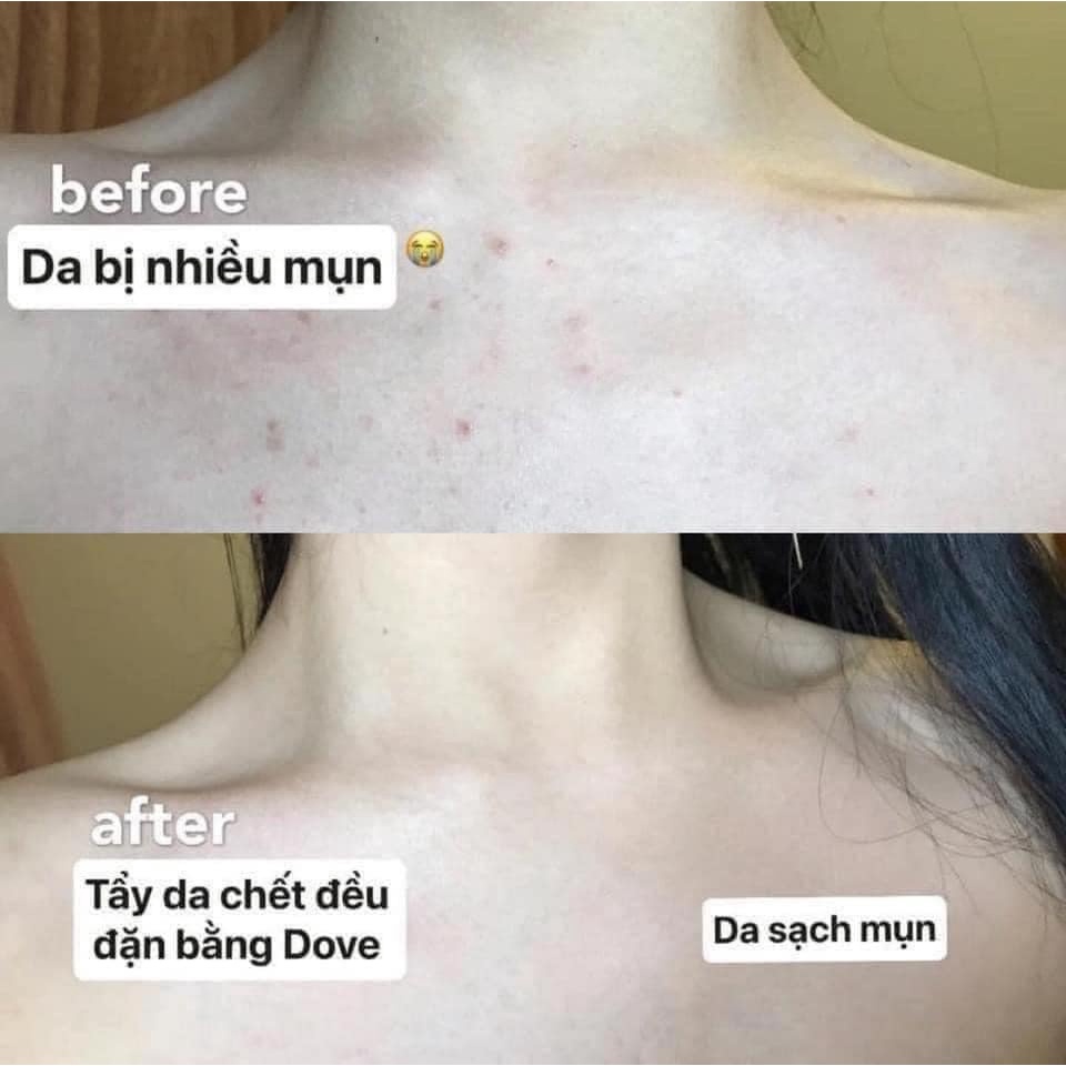 Tẩy da chết body Dove