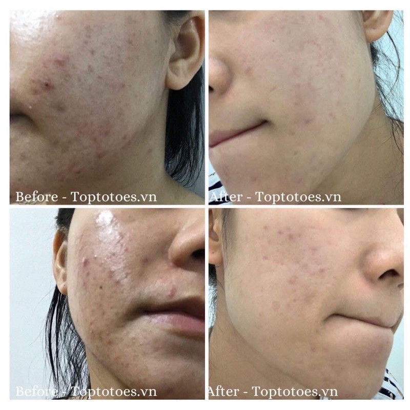 Serum Teana Super Peptides Anti-redness giảm sưng viêm, mẩn đỏ, mụn, phục hồi da