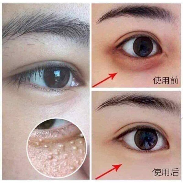 Kem Mụn Thịt Và Quầng Thâm Mắt Gentian Eye Cream