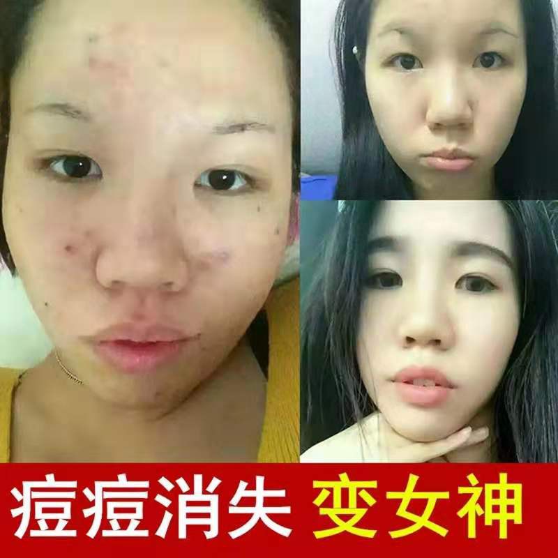 (Hàng Mới Về) Kem Trị Mụn Chiết Xuất Thảo Dược Dành Cho Học Sinh