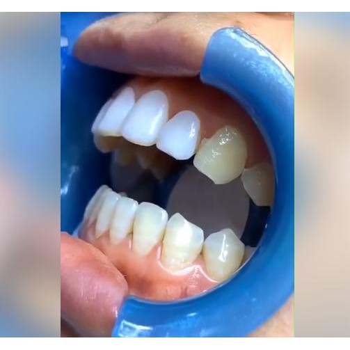 Bộ tạo hình nha khoa_phủ răng sứ biovenees