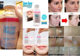 Chấm mụn bye bye blemish