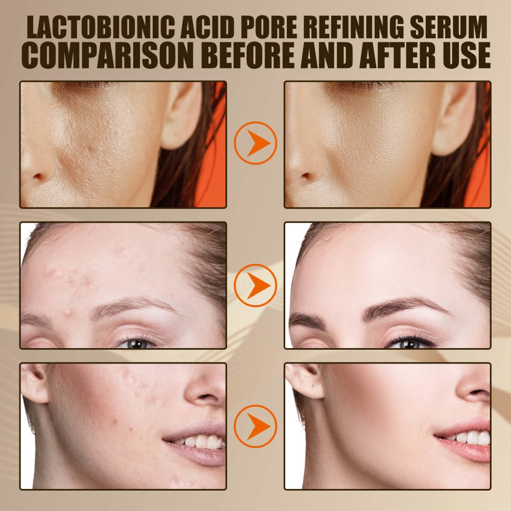 Tinh Chất Thu Nhỏ Lỗ Chân Lông Axit Lactose Hàn Quốc Axit Hyaluronic Làm Săn Chắc Da, Nuôi Dưỡng Da Mặt, Đàn Hồi, Mịn Màng, Sửa Chữa Và Làm Sạch Mụn Đầu Đen Và Mụn Trứng Cá-ampere