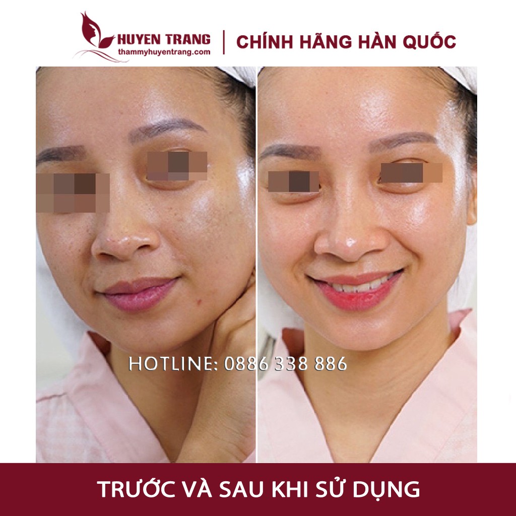 Tế Bào Gốc Hàn Quốc RONAS, serum chăm sóc da, trắng da, se khít, mờ thâm, nám, căng bóng, trẻ hóa da (Tặng nút chiết)