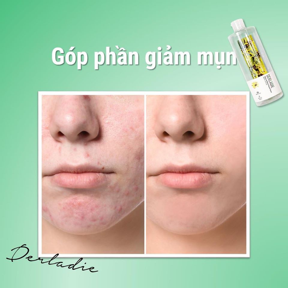 Nước Hoa Hồng Dưỡng Ẩm, Dịu Nhẹ Derladie Natural Witch Hazel -[Coco Shop] | BigBuy360 - bigbuy360.vn