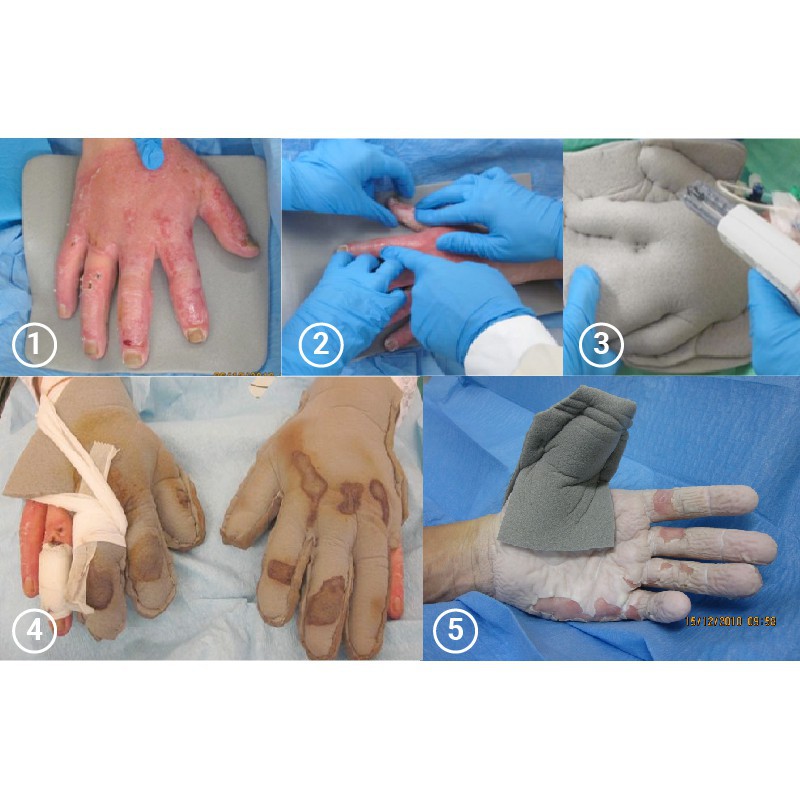 BĂNG VẾT THƯƠNG KHÁNG KHUẨN DẠNG FOAM MEPILEX AG