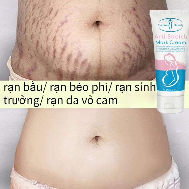 kem rạn da Kem xóa nhăn Kem loại bỏ sẹo 60g làm mờ vết rạn sau sinh làm săn chắc da cho bà bầu làm hết mờ sẹo làm trắng