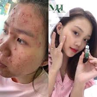 Thảo dược làm sạch mụn, lựa chọn hoàn hảo cho làn da mụn