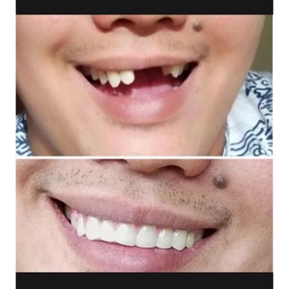 Keo Dán Răng Giả/Sơn Trơn 150 Tốc Độ