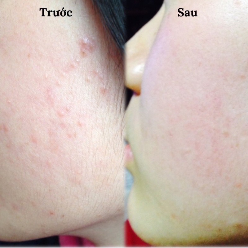 Kem giảm mụn Pair Acne Nhật Bản