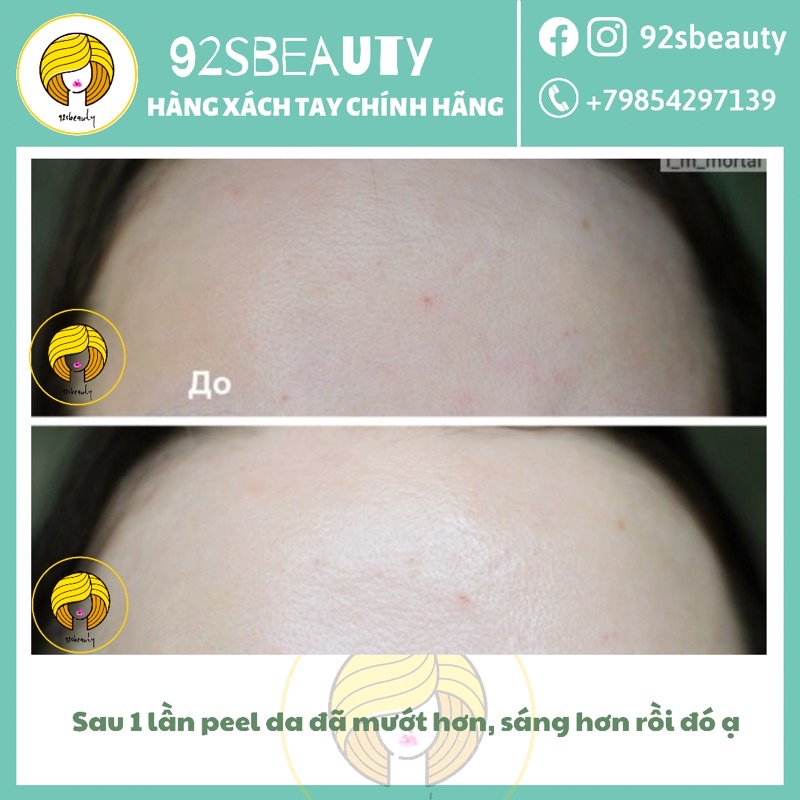 Tẩy da chết hoá học Teana Blue Retinol Rejuvenating Peel cho da căng bóng, láng mướt, giảm mụn