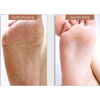 MÁY TẨY DA CHẾT FOOT CARE
