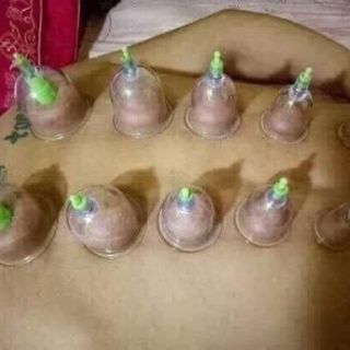 Bộ giác hơi 12 món không dùng lửa